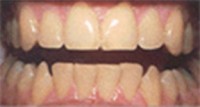 Before and After Picture